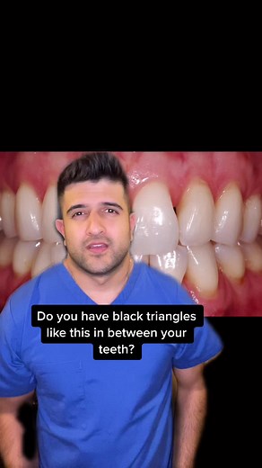How to Fix Black Triangle Gum with Dental Procedures