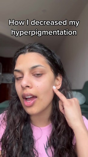 Natural Remedies for Hyperpigmentation on Indian Skin