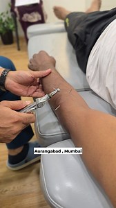 Dry Niddling For Arm pain Relief and Numbness #migren #headache #sciatica | Dr. Mushtaque Syed, Chiropractic & Osteopathy Clinic