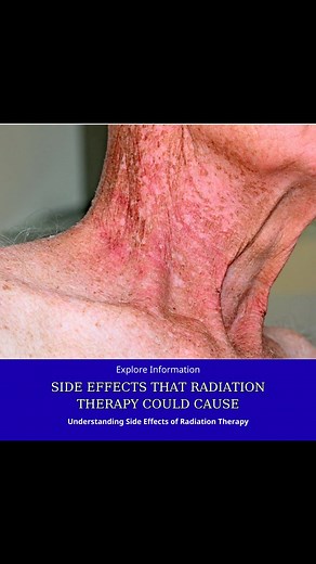 Side Effects That Radiation Therapy Could Cause: A Guide to Useful Information. Learn More | Top Search - Health & Wellness | Facebook