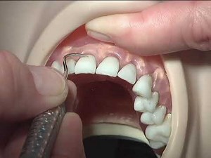 Anterior Sickle Scaler