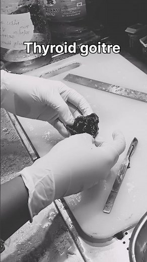 Colloid goitre in the right love of thyroid|#histopathology #thyroiddisorders #thyroidhealth #goitre