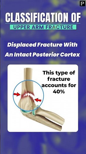Gartland Classification of Supracondylar Humerus Fractures