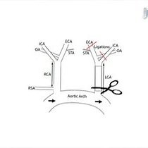 Video: A Model of Disturbed Flow-Induced Atherosclerosis in Mouse Carotid Artery by Partial Ligation and a Simple Method of RNA Isolation from Carotid Endothelium