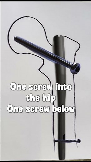 Hip Fracture Surgery in 13 Seconds