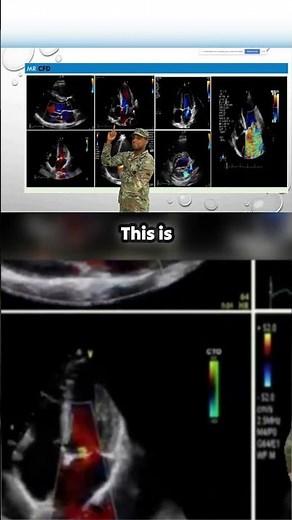 Mild, Moderate, or Severe? How to Accurately Grade Regurgitation on Echo