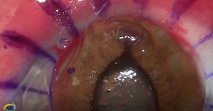 Penetrating Keratoplasty on a Perforated Cornea - Eyetube