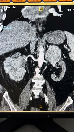 Renal Cell Carcinoma in CT Scan | Kidney Cancer #shorts