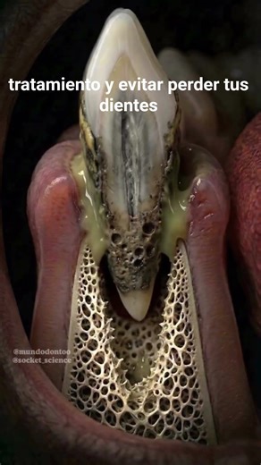 Te explico Claro y sencillo que es enfermedad periodontal 💥 #sabiasque #periodontitis #periodontist
