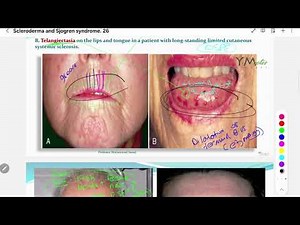 Systemic Sclerosis Qs |Rheum|