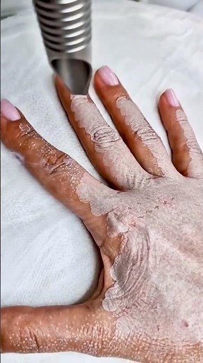 Laser treatment for hand pigmentation removal and skin rejuvenation | Dr KFELATI | #laser #skincare