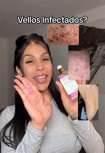 How to Treat Infected Hair Follicles: Insights and Tips