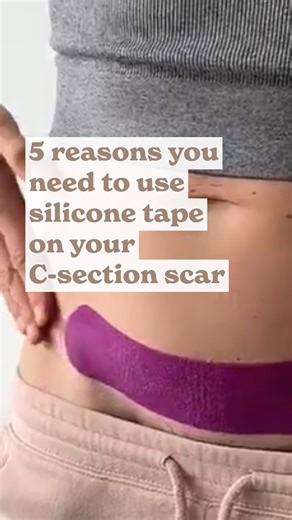 Hannah & Emma | C-section & Postpartum experts on Instagram: "5 reasons you need to use silicone tape on your C-section scar. Covering your scar with a silicone Scarban scar sheet reduces moisture loss to the same level as the surrounding skin. In response, the body stops the supply of stimulating healing factors and the scar will become more flexible, flatter, less red and will settle down more quickly. Any itching or irritation of the scar is also relieved or even prevented. Scarban is medical