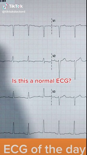 Do u see anything abnormal on here? Routine ECG #cardiology #ecg #doctor