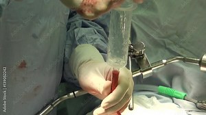 Total gastrectomy. Surgery for stomach cancer, incision on stomach