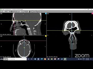 Sinonasal polyposis | Functional Endoscopic Sinus Surgery ( FESS ) | Dr Satish Jain
