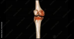 CT Scan of knee joint 3d rendering image turn around on the screen for diagnosis fracture tibia ,fibula and femur bone.