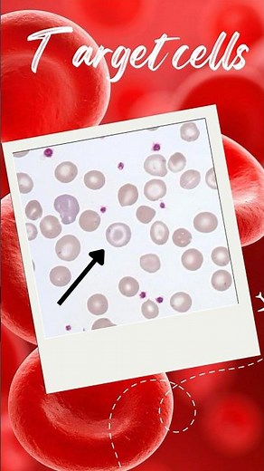 Target Cells #Codocytes# Peripheral Blood Smear