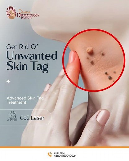 Skin Tag Removal with CO2 Laser | Safe Dermatologist-Led Treatment at DDI