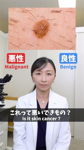 【皮膚科医が解説】このできもの、悪いもの？