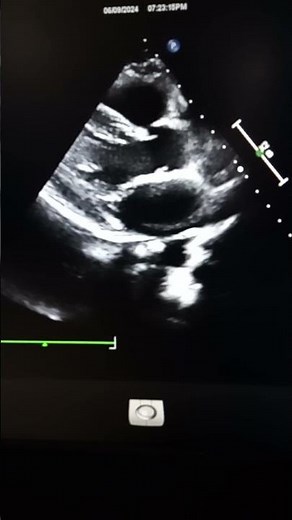 The parasternal long axis (PLAX)