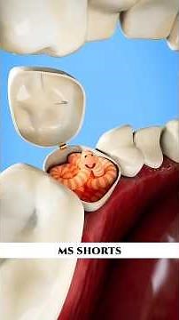 How to get Rid Of Tooth Worm 🐛Dental Fact