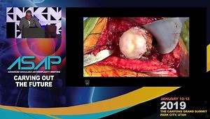 My Top 5 Tricks to Expose the Challenging Glenoid