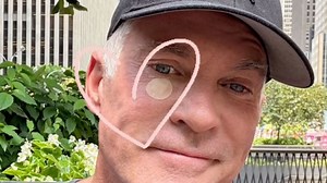 Sam Champion gets skin cancer ‘cut out’ from face in concerning new photo
