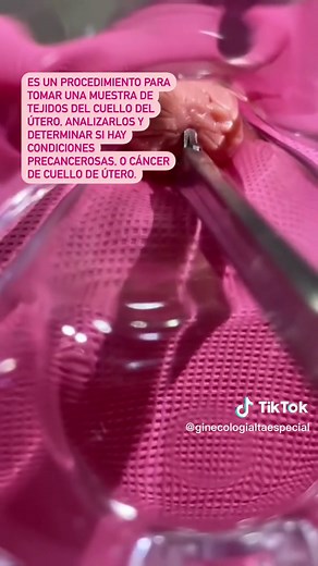 ¿Por qué se realiza una biopsia de cérvix y cómo se hace? 🧐 Te cuento con detalle en el video. 🙌🏼 💜 #ginecologia #ginecologa #locuentoentiktok #aprendeentiktok #aquemededico #culturatiktok