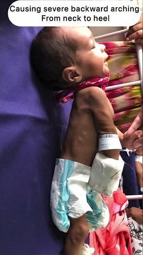 Posturing in newborn- opisthotonos | pediatrics #shorts #newborn #pediatrics