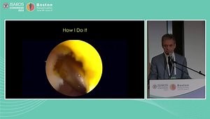 PCL Reconstruction My Way: Transtibial Single-Bundle Reconstruction Technique
