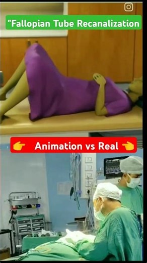 "Fallopian Tube Recanalization: Real Procedure vs Animation | Must Watch! #thelearningfacts#nursing
