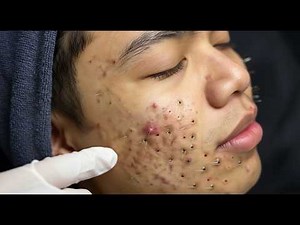 Loan Nguyen Acne Treatment 15hh