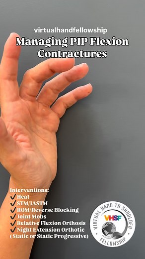 Managing PIP Joint Flexion Contractures: This weekend’s case discussion highlighted a common secondary sequela following dorsal dislocation injuries involving volar plate disruption and volar plate avulsion fractures: managing PIP flexion contractures when these injuries lead to soft tissue restrictions. In this short video,we discuss several effective strategies, including: ✔️ Soft tissue and instrument-assisted massage ✔️ Joint mobilization techniques ✔️ Reverse blocking exercises ✔️ Relative 