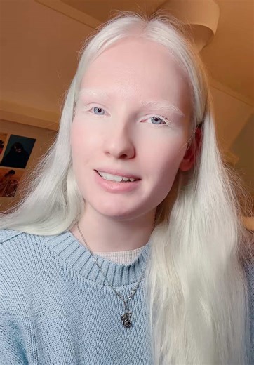 #albino #albinism #fyp #viral #teenager | albinism