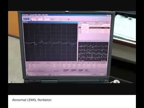 Laryngeal Electromyography-Guided Hyaluronic Acid Vocal Fold Injection Procedure