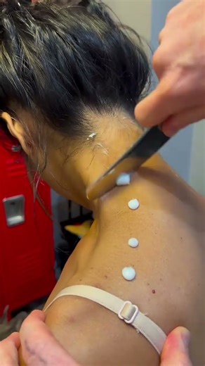 Iastm tools massage #iastm #cupping #cervical #massage #trending #neckpain #dryneedling