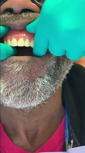 implant supported overdenture- retention inside mouth