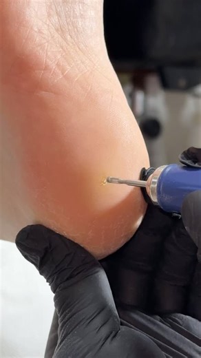 Nails master on Instagram: "Удаление стержневой мозоли — это не просто убрать «сверху». Важно полностью удалить стержень, чтобы боль не возвращалась. Работаю бережно и аккуратно: ✔ без травмирования здоровой кожи ✔ без боли ✔ с соблюдением всех норм обработки Комфорт ваших ног — моя главная задача 💙"