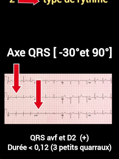 l'interpretation de ECG #طب #طبيبة #doctor #docteur #ecg #ECG #ecginterpretation
