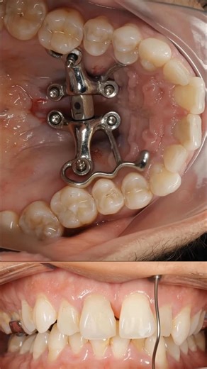 Dr. Svitlana Koval | What are the biggest fears about MARPE and Midpalatal Piezocorticotomy? Q: Are there any complications with 3D GUIDED Midpalatal... | Instagram