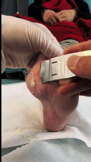 How to Remove Thick Yellow Calluses from Feet | Safe Professional Foot Care #callusremoval