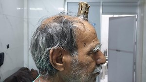 74-year-old MP man grows devil’s horn after injury