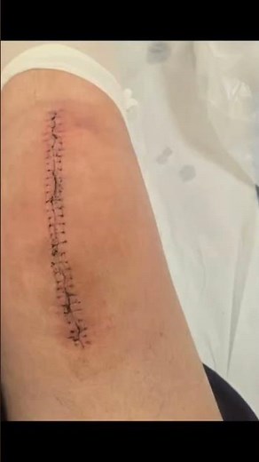 Surgical Clip Removal