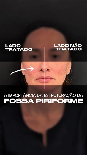 Daniel Coimbra on Instagram: "A fossa piriforme é uma das primeiras áreas a perder massa óssea com o envelhecimento. ⠀ A reestruturação dessa região com bioestimuladores ou preenchedores injetáveis é essencial para recuperar o suporte do terço médio da face, suavizar sulcos profundos e melhorar o contorno facial de forma natural e harmônica. ⠀ Avaliação individualizada, técnica precisa e conhecimento anatômico são indispensáveis para resultados seguros e eficazes. ⠀ #RejuvenescimentoFacial #Foss