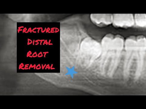 Fractured Root Removal Molar Extraction