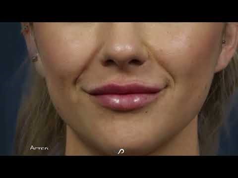 Fillers vs BOTOX - Which is Better?