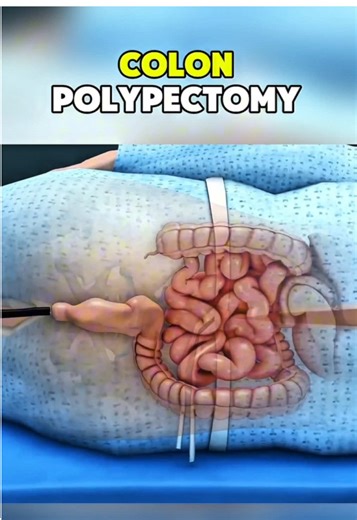 How colon polyps are removed with a colon polypectomy? #ColonPolypectomy #PolypRemoval #ColorectalHealth #ColonHealth #PolypPrevention