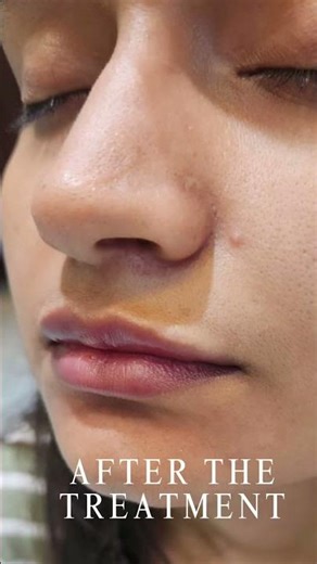 Lip & Nose Enhancement Transformation! | Experience the art of subtle enhancement