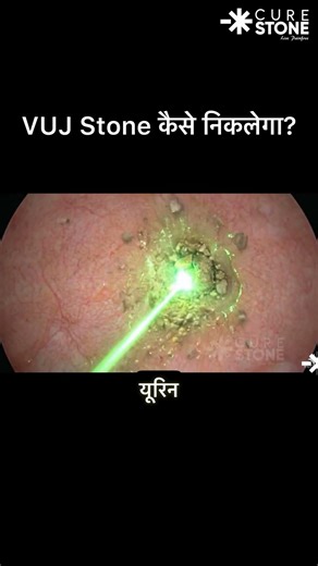 Laser Blasting a STUCK Ureteric Stone! 💥 (Satisfying 3D)